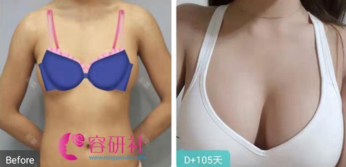 韩国UCANB整形外科医院隆胸案例