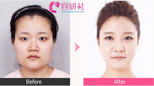 韩国NJH整形医院面部轮廓手术案例术前术后对比图