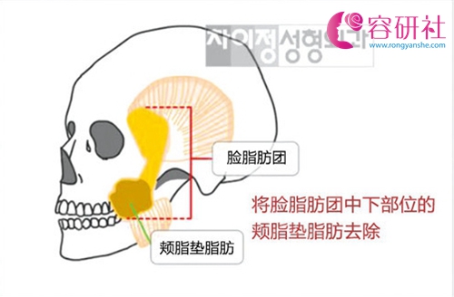 韩国车李郑整形医院做颊脂垫摘除手术，效果怎么样？价格贵吗？