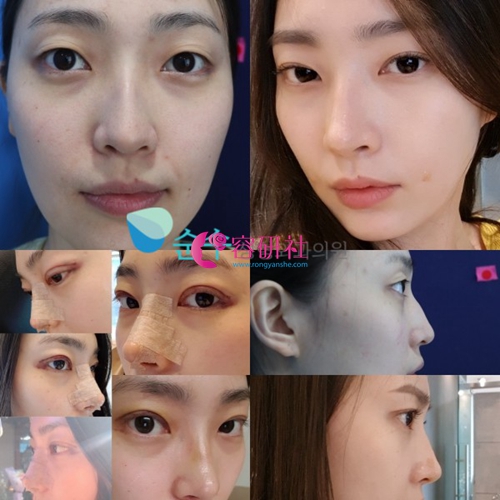 韩国纯真整形外科鼻部综合案例
