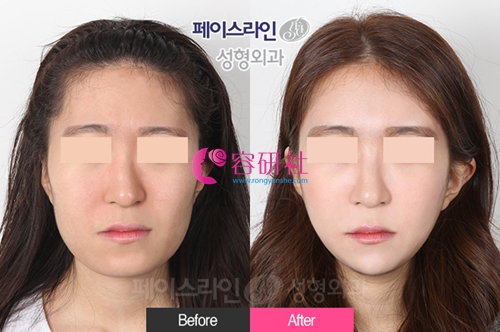 韩国FACELINE菲斯莱茵整形外科颧骨下颌角改善案例