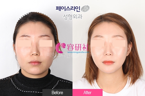 韩国FACELINE菲斯莱茵整形外科下颌角改善案例