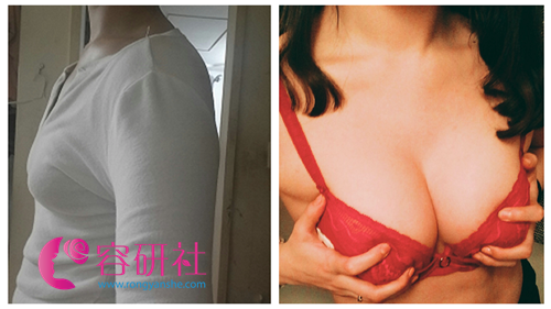 韩国glam整形外科隆胸案例