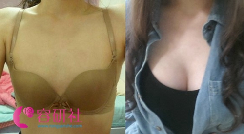 韩国glam整形外科隆胸案例