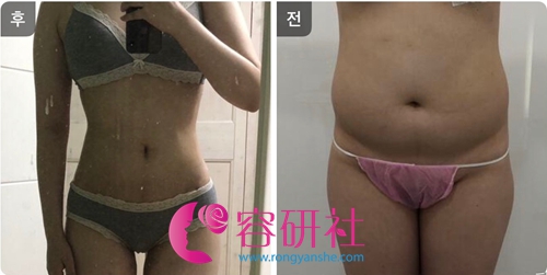韩国babiline芭比莱茵云整形医院女院长腰腹吸脂案例