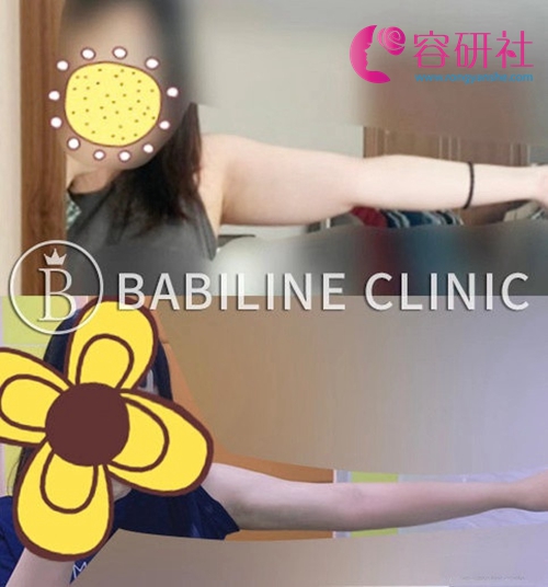 韩国babiline芭比莱茵云整形医院女院长手臂吸脂日记