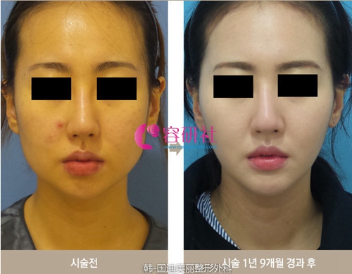 韩国迪美丽整形外科v脸吸脂日记