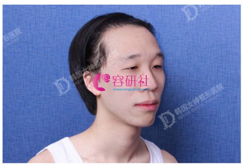 韩国女神整形外科男士轮廓案例手术前45度