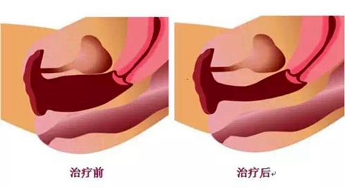 韩国好手艺医院后方膣圆盖术技术优势