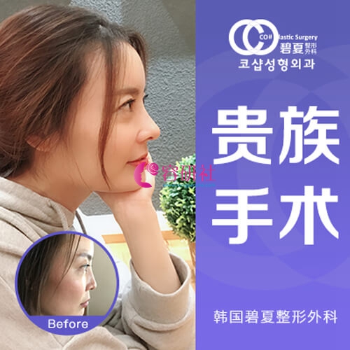 韩国碧夏整形外科鼻基底填充手术案例