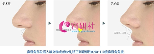 韩国宝士丽整形外科鼻基底填充示意图