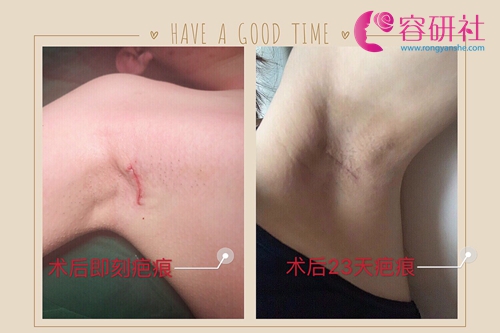 韩国profile普罗菲耳整形医院腋下疤痕