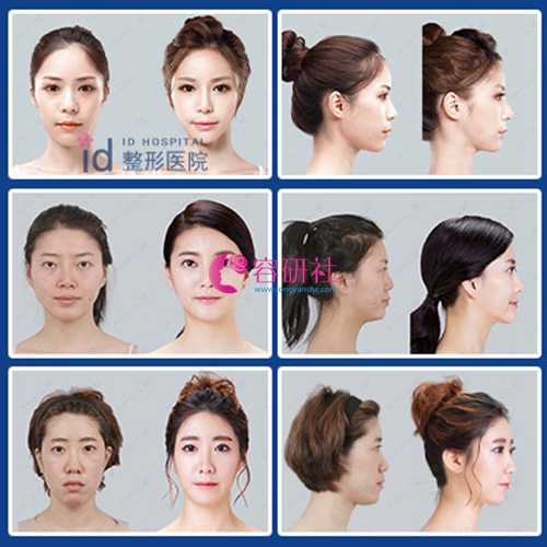 韩国ID整形医院轮廓四件套案例