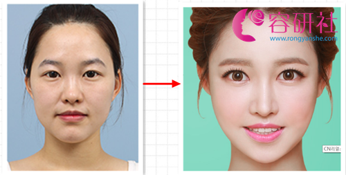 韩国爱我整形医院面部轮廓案例术前术后对比