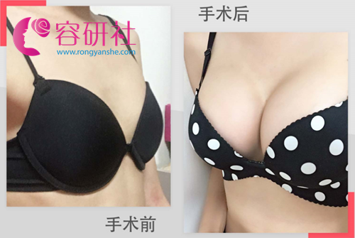韩国NANA整形医院双平面plus隆胸对胸部下垂效果好吗?