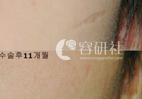 韩国Dr.ham小面积疤痕治疗效果