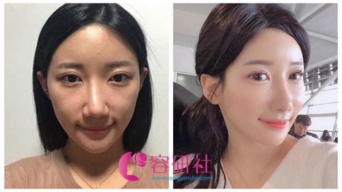 韩国秀美颜整形外科鼻修复案例