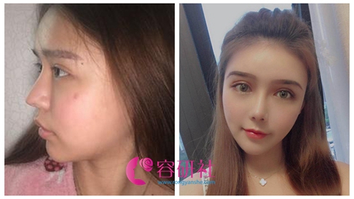 韩国秀美颜整形外科鼻修复案例