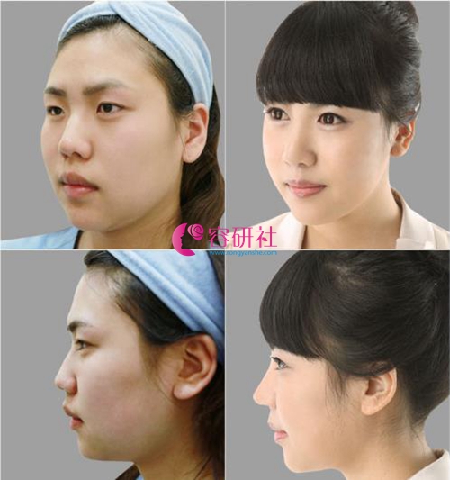 韩国欧佩拉整形外科面部轮廓手术案例