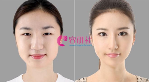 韩国欧佩拉整形外科面部轮廓手术改善后