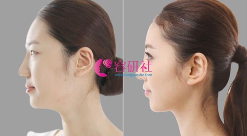 韩国欧佩拉整形外科鼻综合手术日记