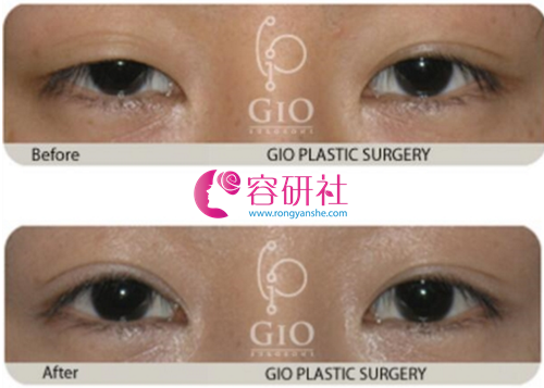 韩国gio整形外科双眼皮修复手术