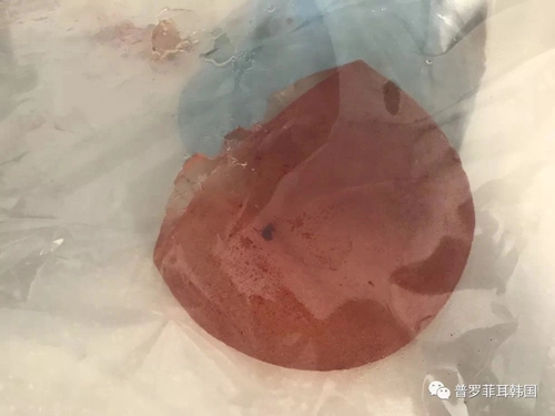 普罗菲耳profile医院官网发布的胸部修复手术左胸取出后的假体