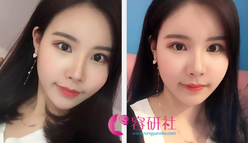 韩国秀美颜眼鼻手术术后2个月