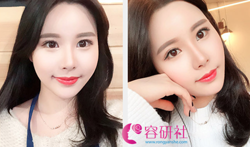 韩国秀美颜眼鼻手术术后6个月