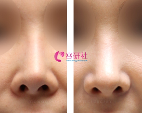 韩国高恩世上整形外科鼻头修复案例