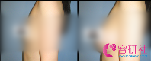 韩国UMNAGUMO整形外科假体隆胸案例