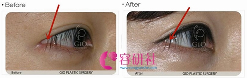 韩国gio整形外科眼角修复案例