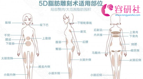 韩国纯真整形外科5D脂肪雕刻术适用部位