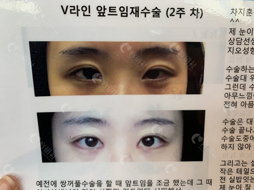 韩国GIO整形外科眼角修复案例
