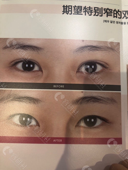 韩国soonplus整形外科双眼皮案例