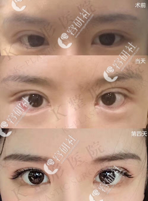 韩国k整形医院外眼角下zhi糖果眼角案例恢复过程图