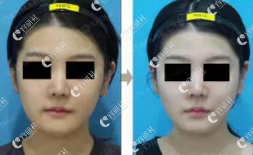 韩国迪美丽整形外科面部吸脂案例