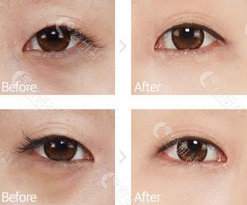 韩国st整形外科祛黑眼圈、眼袋案例