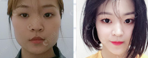 韩国宝士丽整形医院开眼角手术前后对比照
