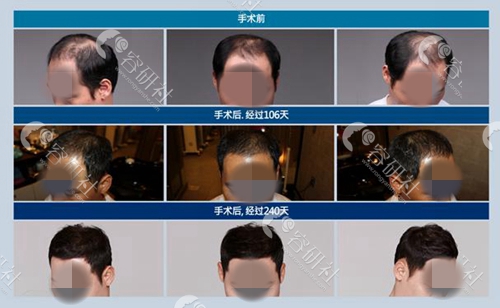 韩国毛杰琳整形外科男士秃顶改善案例
