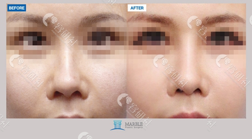 韩国玛博尔整形外科鼻修复手术案例