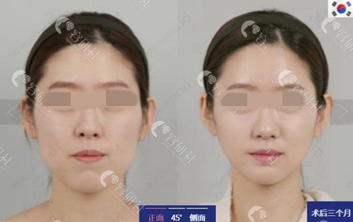 韩国ID整形外科下巴改善手术案例