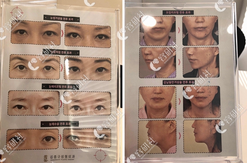 韩国k整形医院眼睛修复手术和提升手术日记