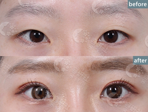韩国1mm整形外科医院双眼皮不对称矫正案例
