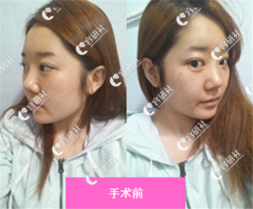 韩国id整形医院朴相熏下颌角手术前日记照片