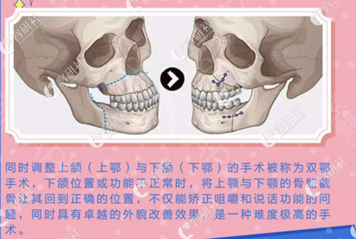 韩国必妩整形医院纳米双颚手术