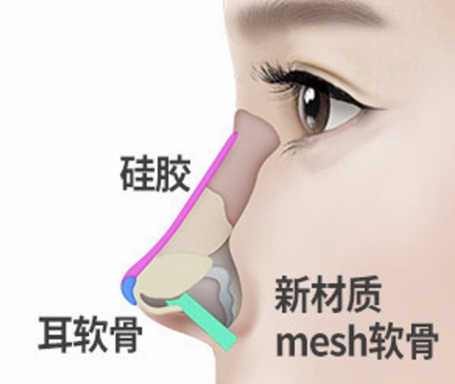 硅胶、耳软骨、新材质mesh隆鼻植入位置示意图.jpg