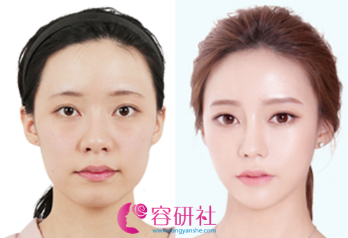 面部轮廓手术案例