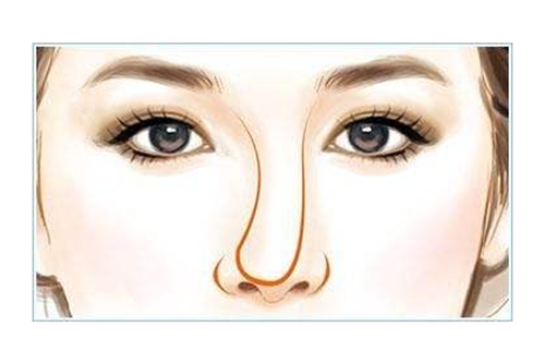 为什么隆鼻术后鼻子会歪？