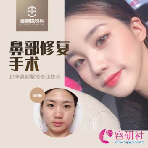 韩国微笑整形外科鼻部修复手术日记
